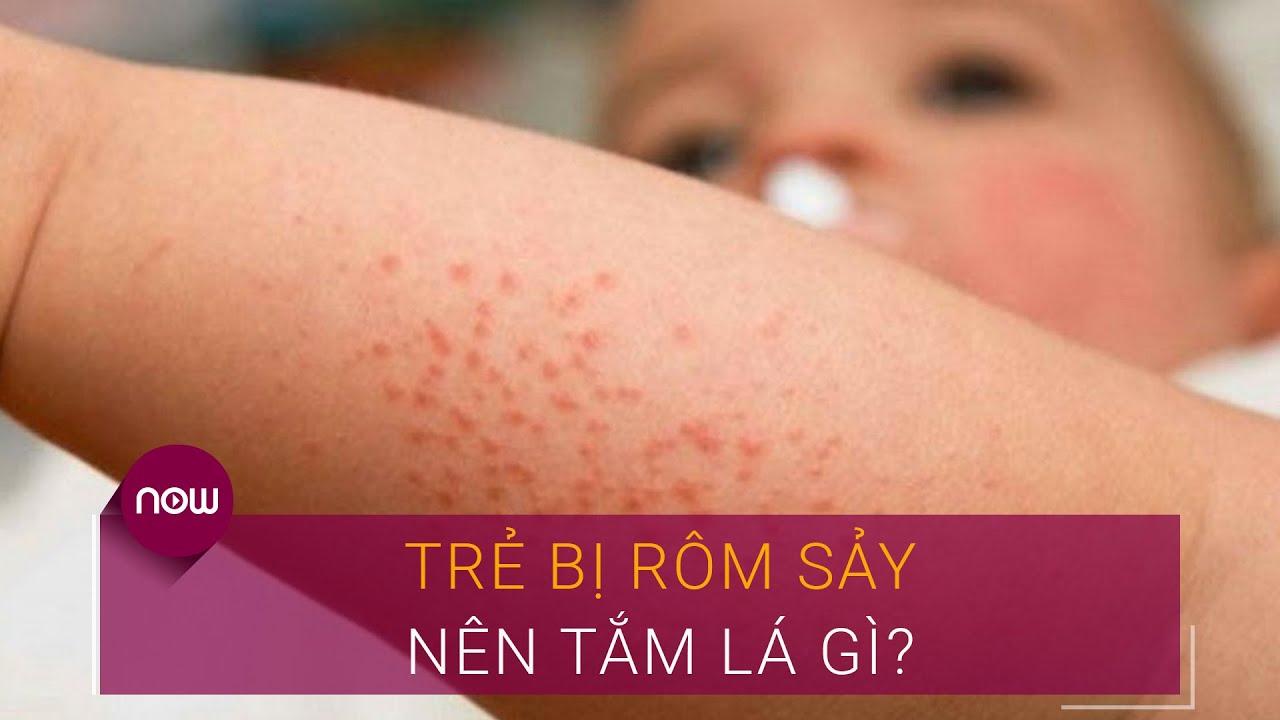 Rôm sảy là bệnh thường gặp ở trẻ nhỏ trong những ngày nắng nóng và ẩm ướt, nhiều người thường nghĩ tới cách tắm lá cho trẻ. Vậy khi bị rôm sảy nên tắm lá gì?