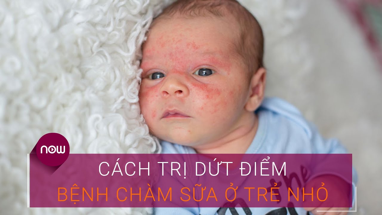 Cách trị dứt điểm bệnh chàm sữa ở trẻ nhỏ