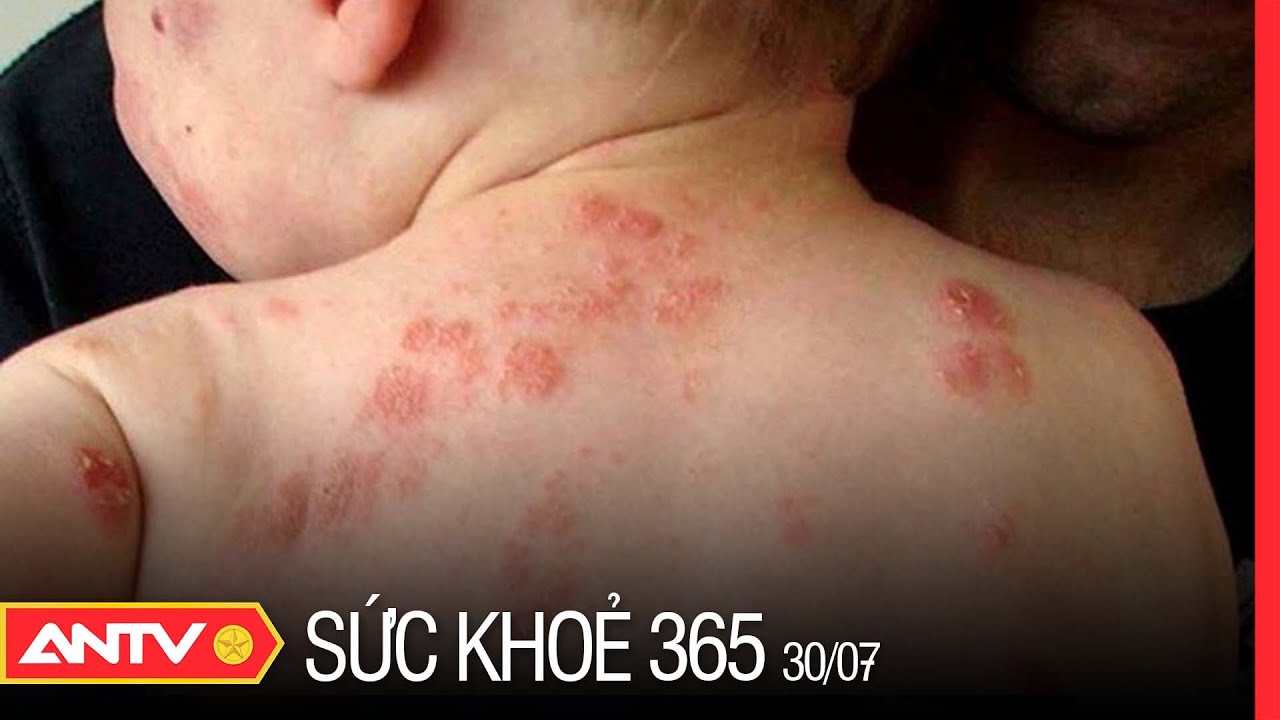 Cách chăm sóc và phòng ngừa bệnh viêm da cơ địa ở trẻ nhỏ | Sức khỏe 365 | ANTV