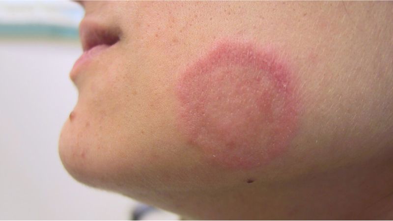 CÁCH ĐIỀU TRỊ HẮC LÀO - NGUYÊN NHÂN GÂY BỆNH VÀ TRIỆU CHỨNG