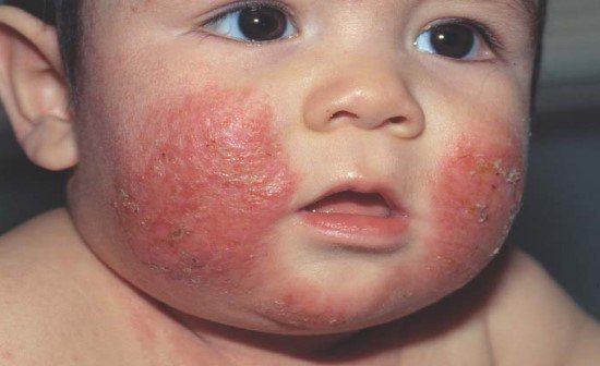 VIÊM DA CƠ ĐỊA Ở BÉ VÀ CÁCH CHĂM SÓC, ĐIỀU TRỊ HIỆU QUẢ NHẤT